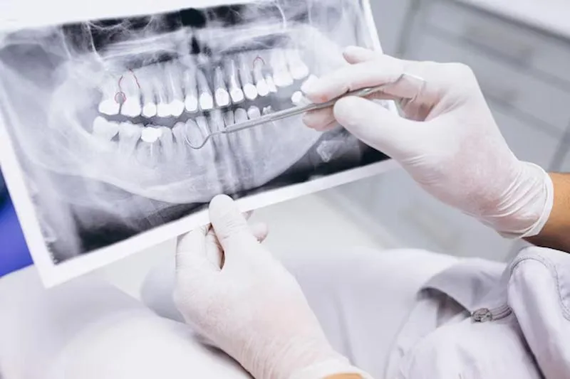 Why Choose Digital Dental X-Rays?