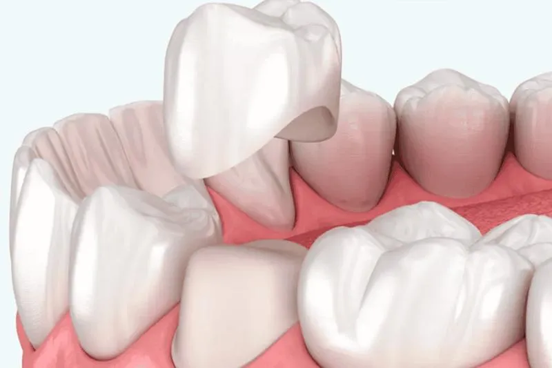 Dental Crowns