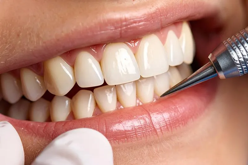 Tooth-Colored Fillings