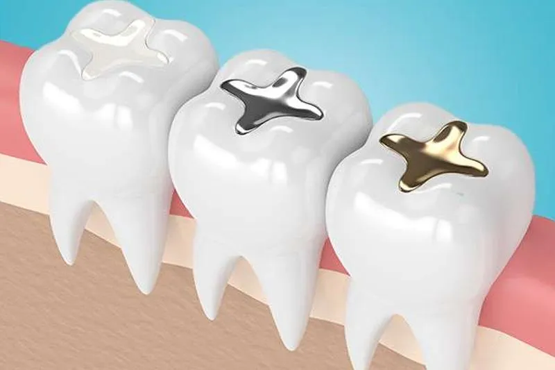 Why Choose Composite Fillings?