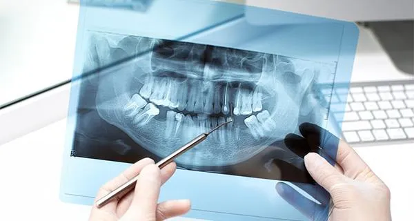 Digital X-rays & Panoramic Imaging