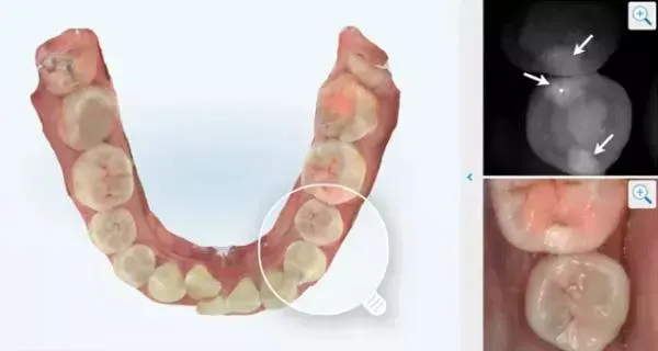 Radiation-Free Cavity Detection Using NIRI Technology