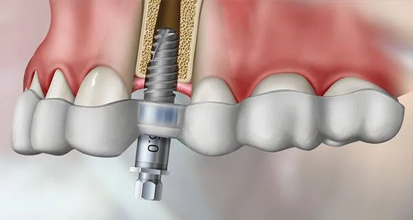 CBCT & Guided Implant Placement