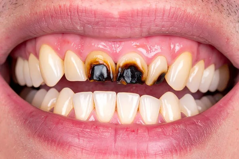 Restorative Dentistry in Sacramento
