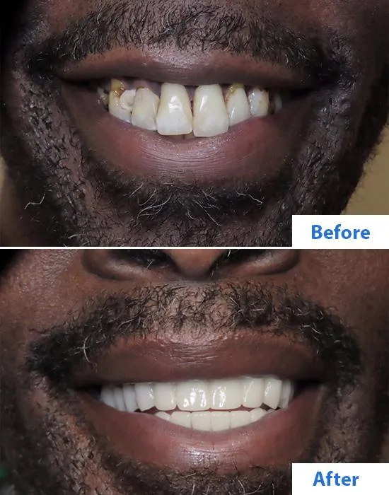 Are dental implants right for me?