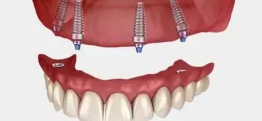 All on 4 Dental Implants