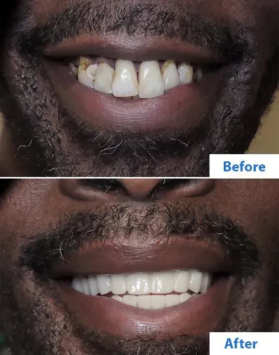 Are dental implants right for me?
