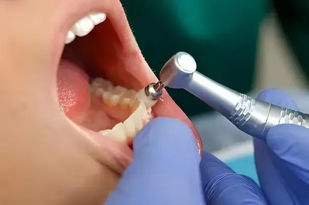 Deep Teeth Cleaning Near Sacramento CA