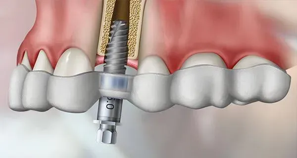 CBCT & Guided Implant Placement