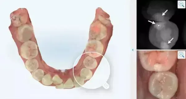 Radiation-Free Cavity Detection Using NIRI Technology