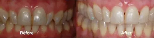 Invisalign 