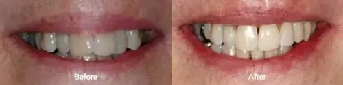 Invisalign 