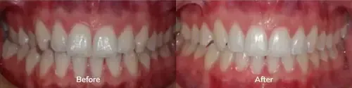 Invisalign 