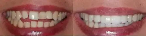 Invisalign 