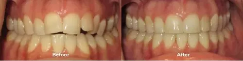 Invisalign 