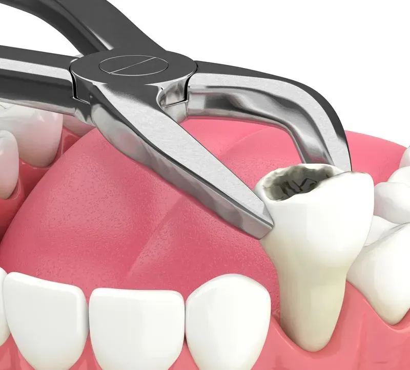 Emergency Tooth Extraction – Fast Relief When You Need It Most