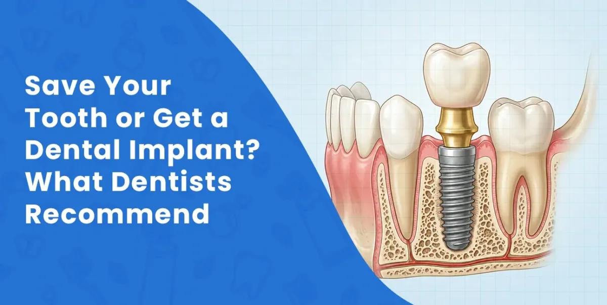Save Your Tooth or Get a Dental Implant in Sacramento, CA? Dentist Explains