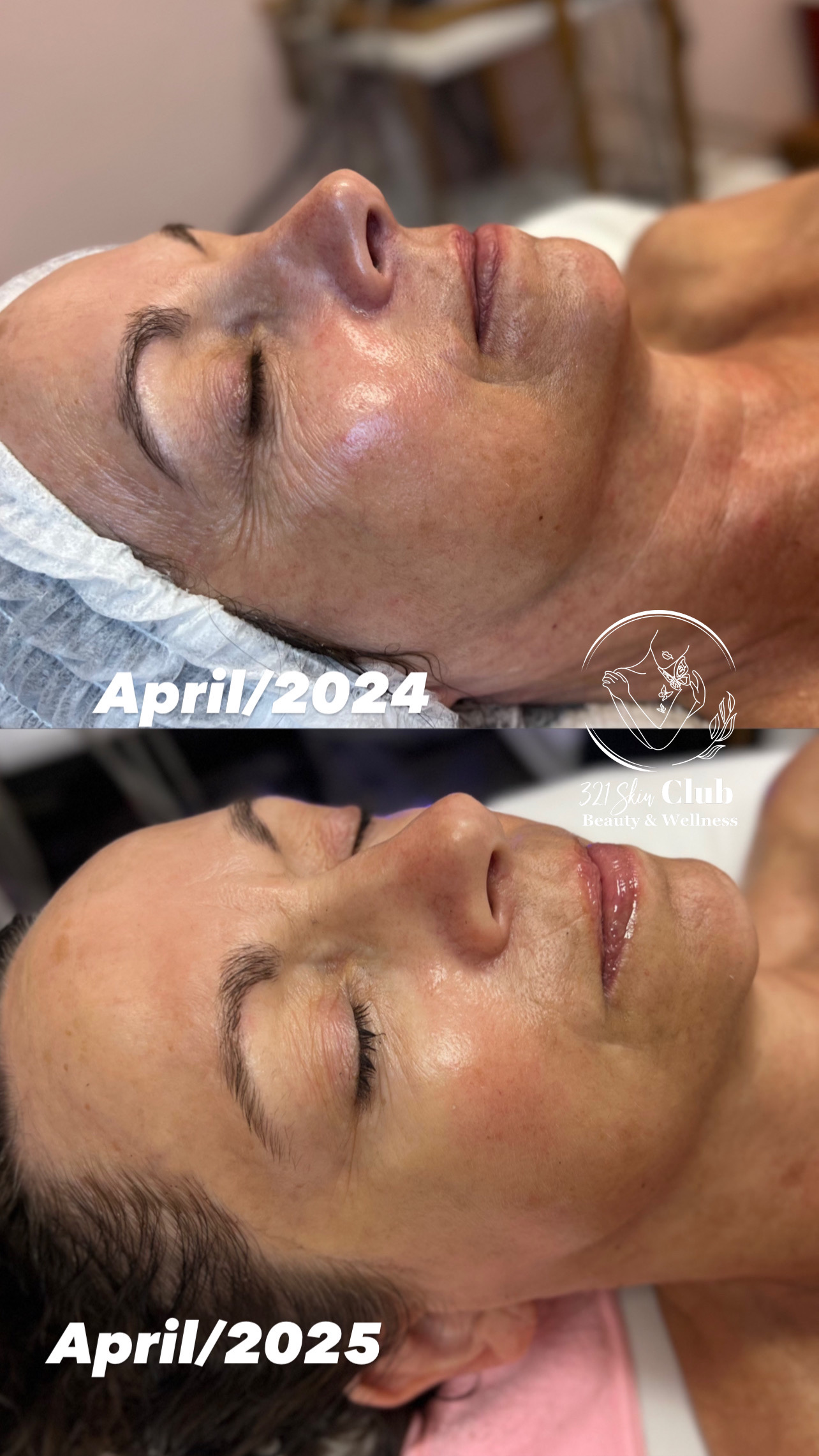 One year of luxe lift facials results