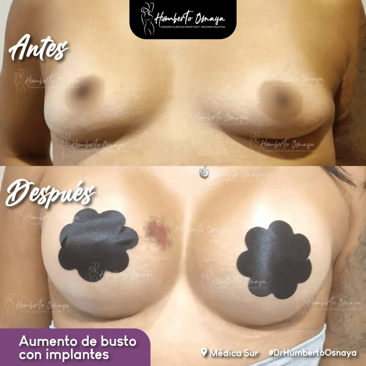 Resultados antes y después de ginecomastia