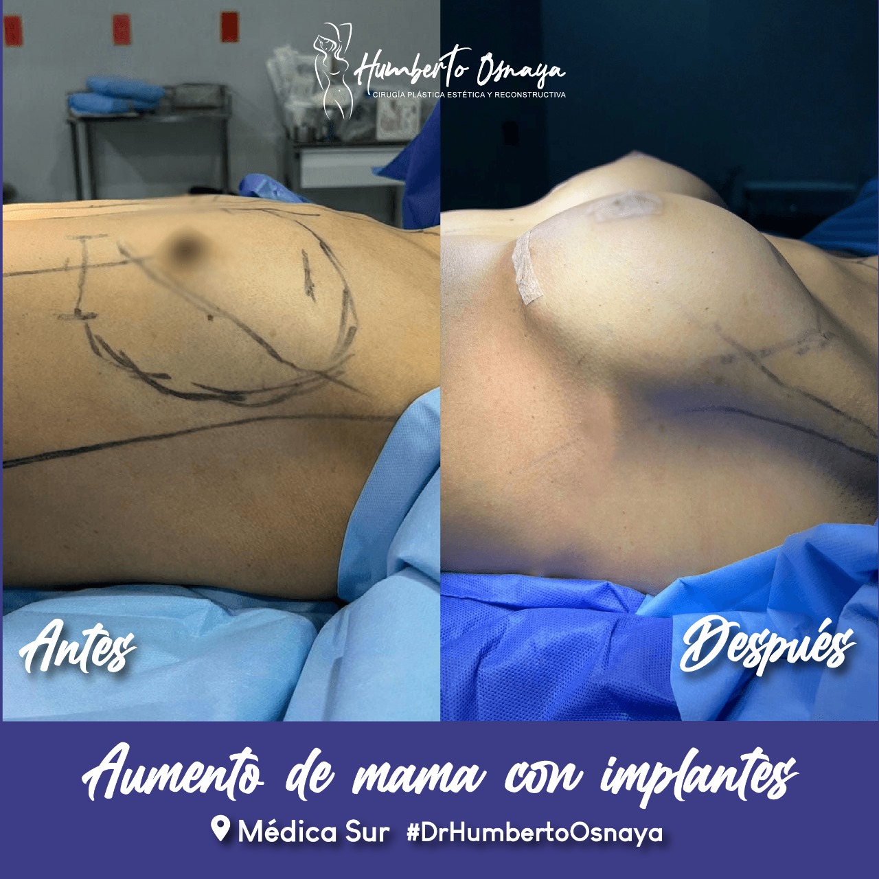 Paciente masculino antes y después de corrección de ginecomastia