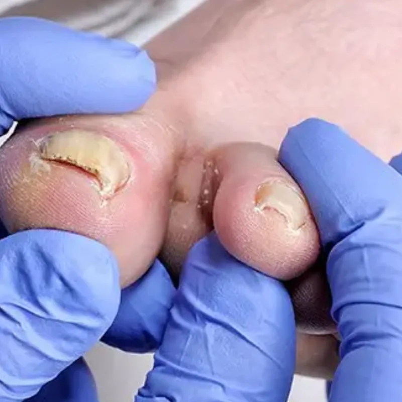 Fungal Nail Treatment