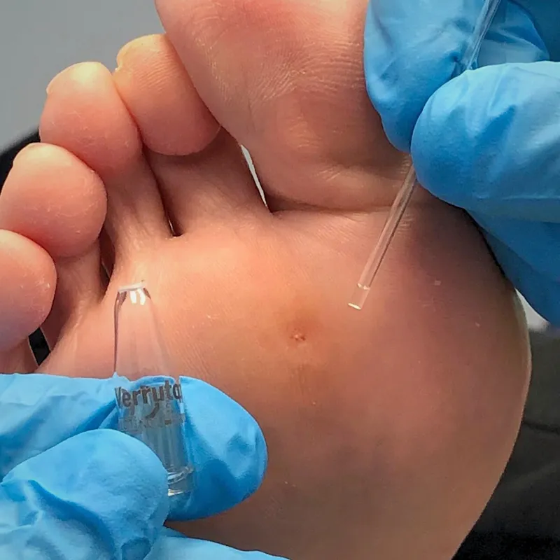 Verrucae Wart Treatment