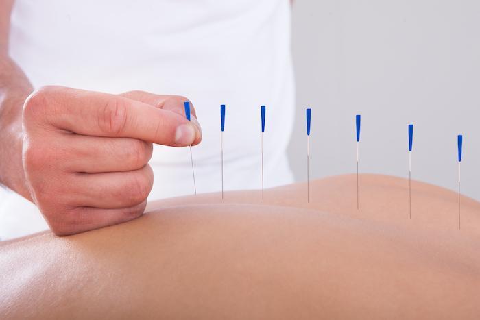 What Is Dry Needling?