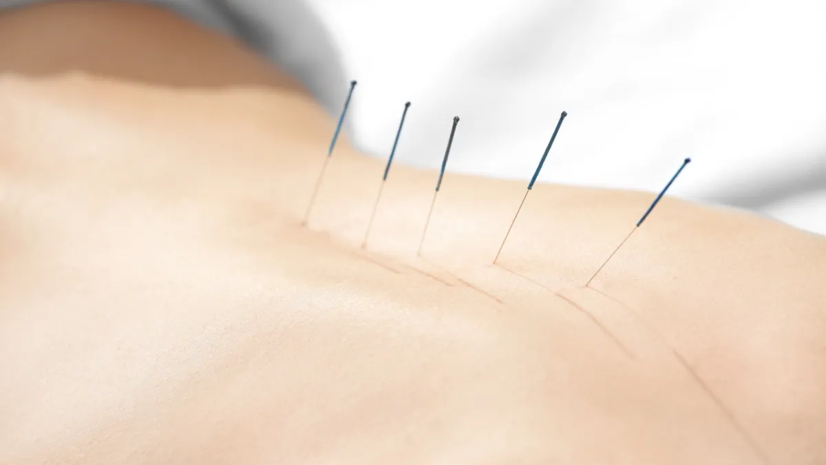 Acupuncture