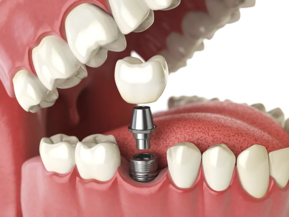 Single dental implant