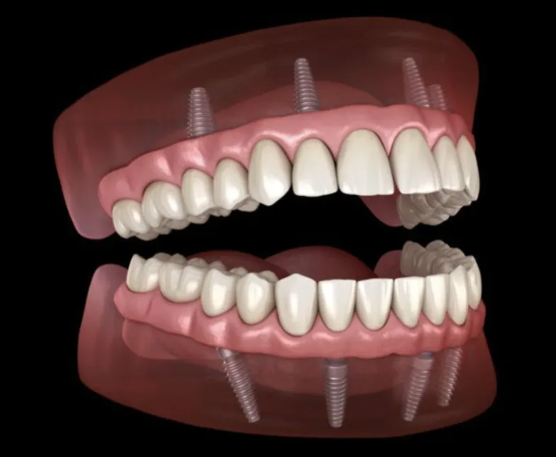 Full arch dental implant restoration
