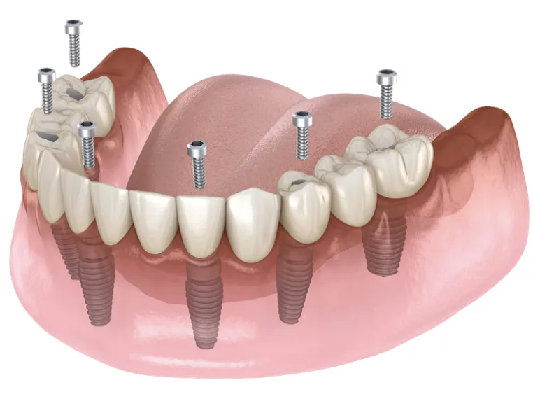 Non-removable full arch implants