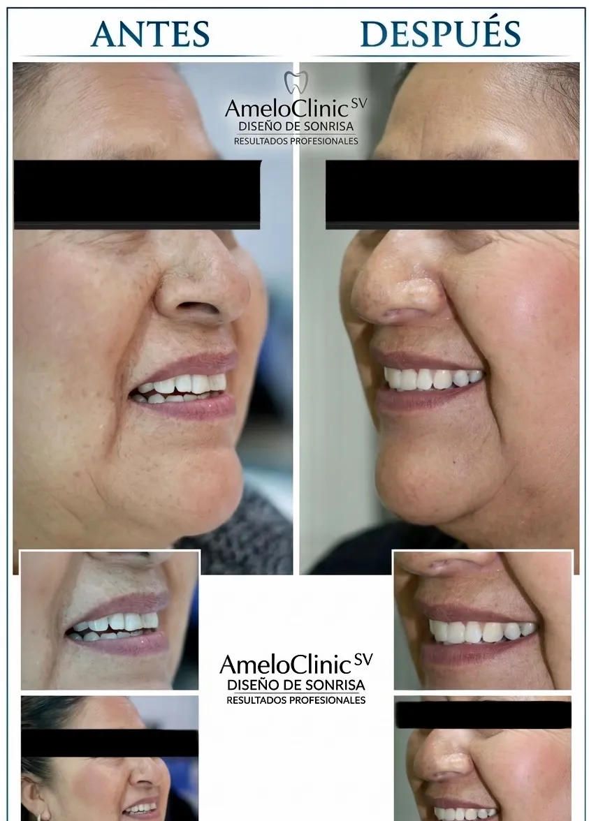 Resultado de paciente - Rinoplastia