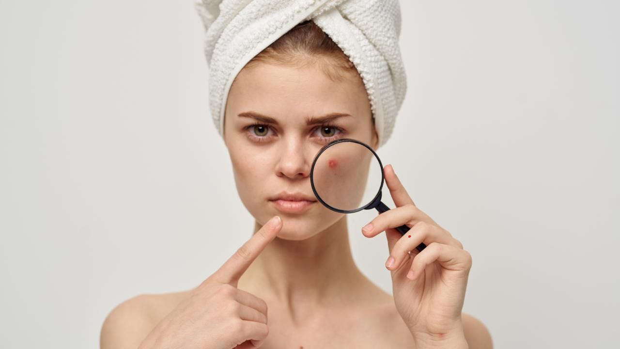 How to Treat Acne: Effective Skincare Tips and Solutions