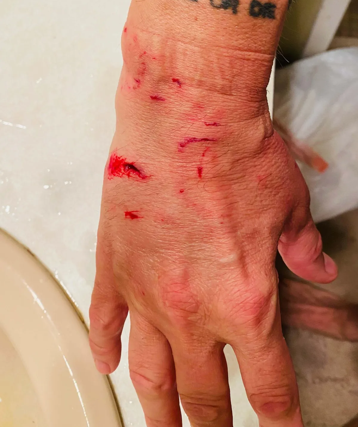 A hand with a severe dog bite wound, showing bleeding and injury from an animal attack. Our Bronx dog bite lawyers help victims seek compensation for medical treatment, pain, and suffering.