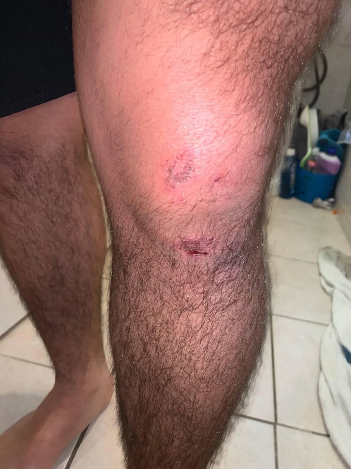 Our client’s swollen and cut knee after an NYC bus accident, highlighting the severity of bus-related injuries. Our Bronx personal injury lawyers help victims seek compensation for medical treatment, lost wages, and pain and suffering