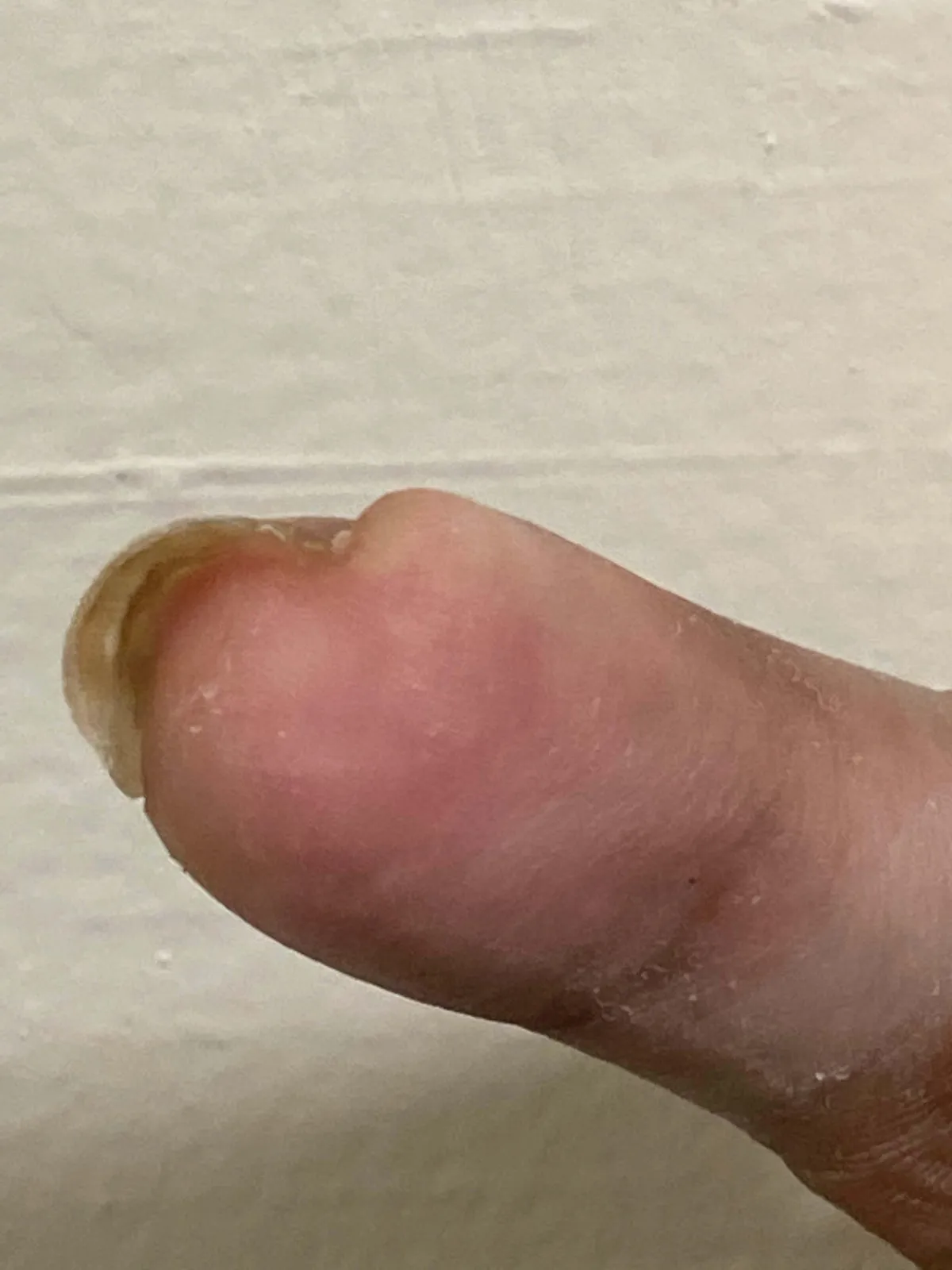 "Our client's disfigured finger after getting caught in a door, highlighting the severity of crush injuries. Our Bronx personal injury lawyers help victims seek compensation for disfigurement and hand injury lawsuits