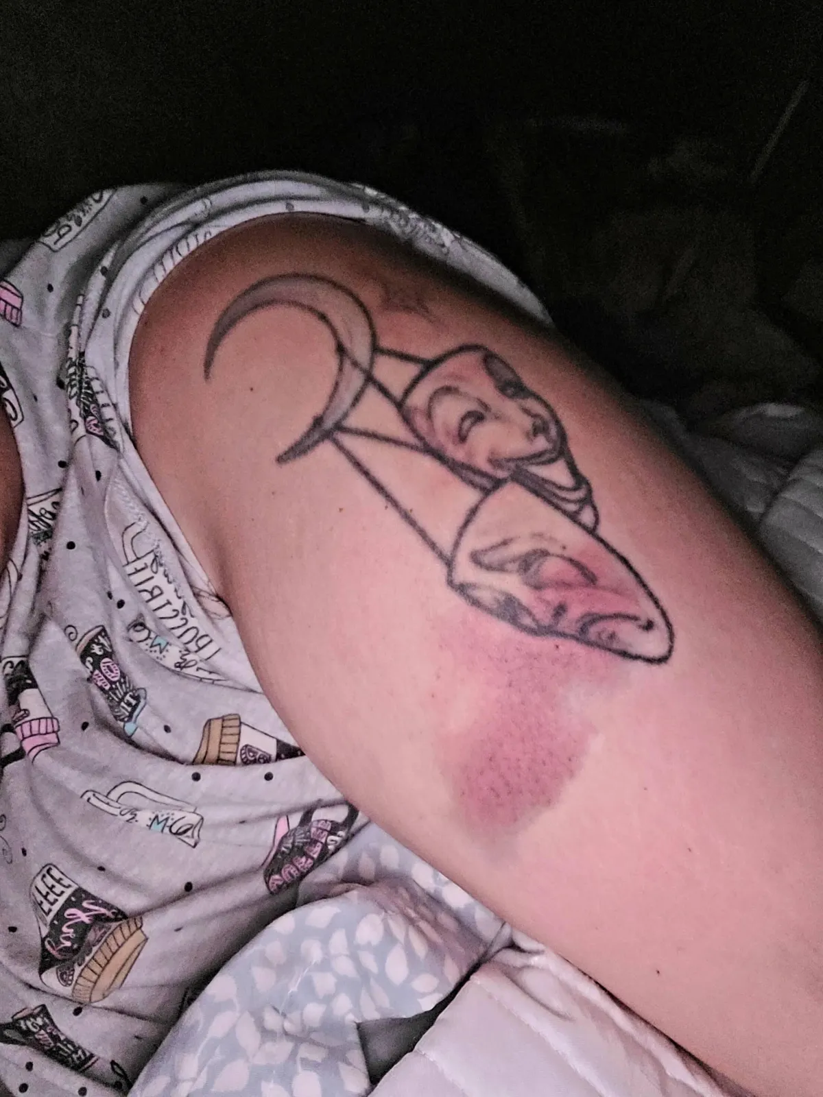 Our client's bruised arm from a negligent security incident at a Bronx venue, highlighting the dangers of inadequate safety. Our Bronx negligent security lawyers help victims seek compensation for injuries caused by security failures."