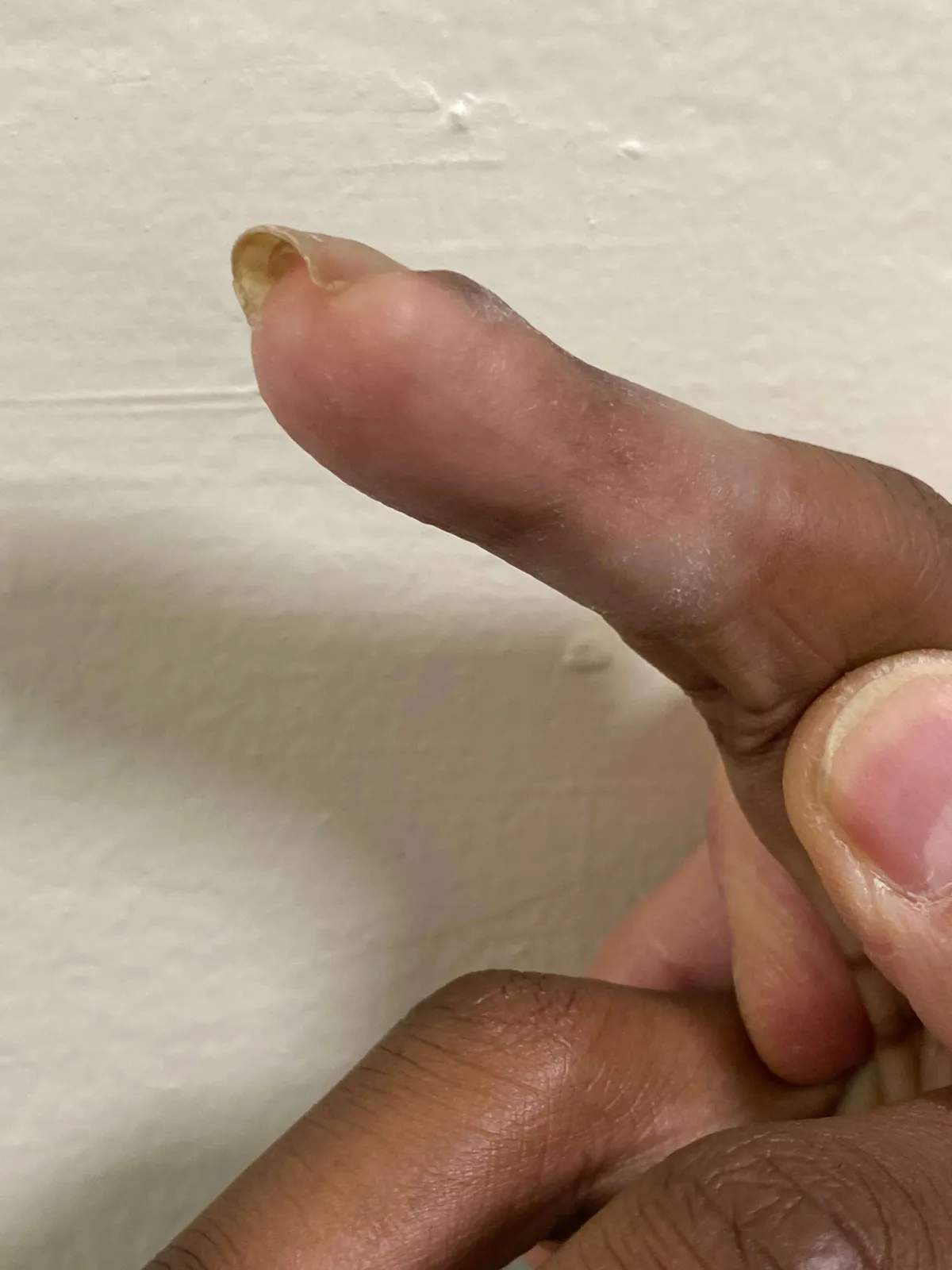 A close-up of a severely injured finger caused by a faulty door mechanism. The image highlights the damage suffered due to a defective product, emphasizing the need for legal action in product liability cases.