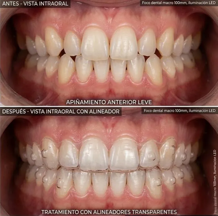 Ortodoncia estética profesional en bogotá