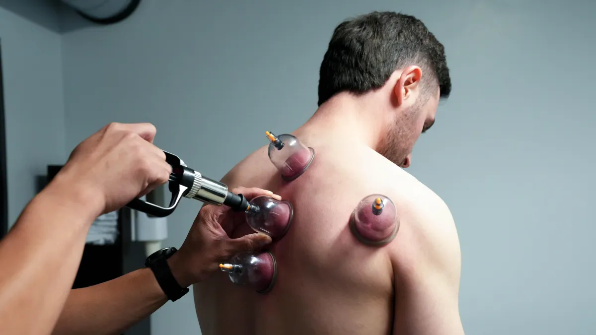Male physical therapy patient receiving myofascial decompression cupping treatment