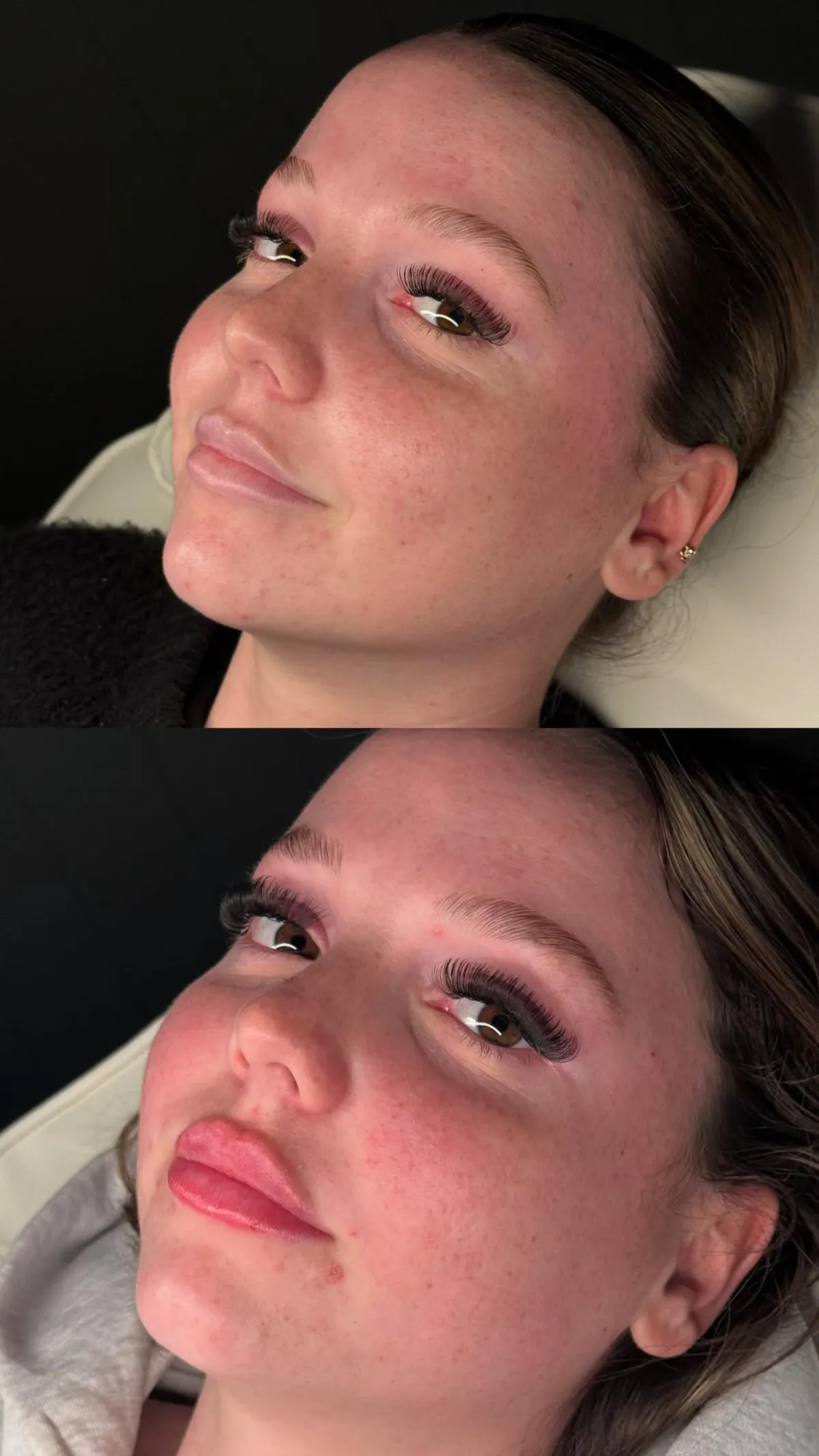 Lip Filler Before After