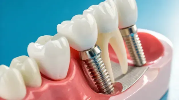 Implants & Bridges Orihuela Costa