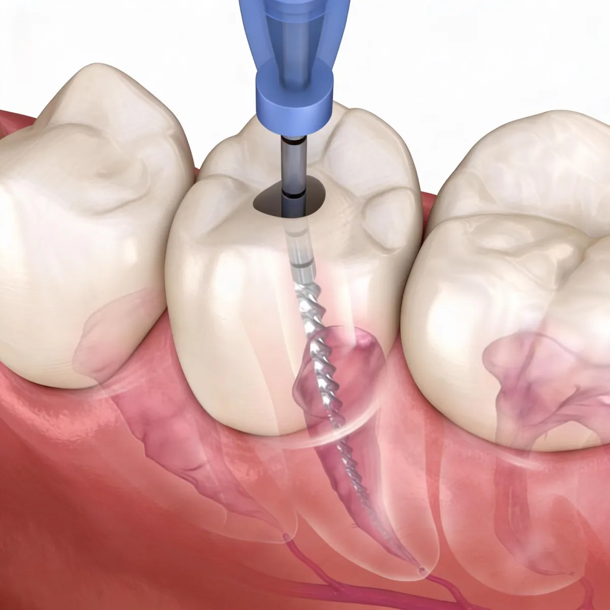 Root Canal Treatment in Bukit Jalil