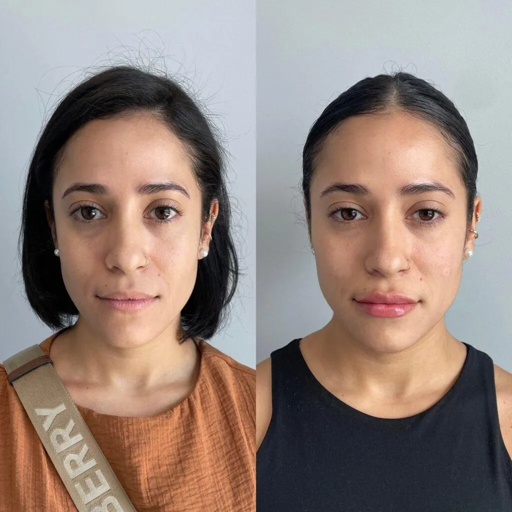 Before and healed lip-treatment result shown in matched close-up views