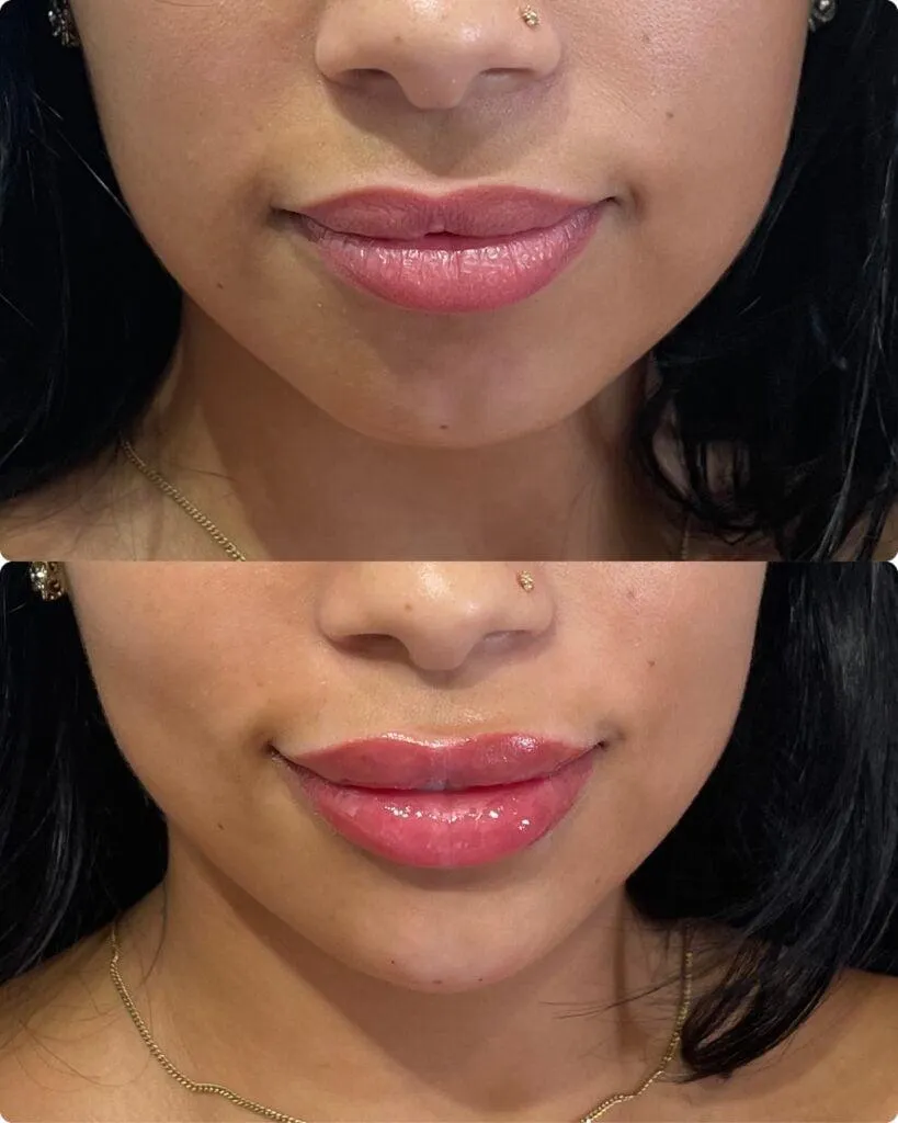 Before and healed lip-treatment result shown in matched close-up views