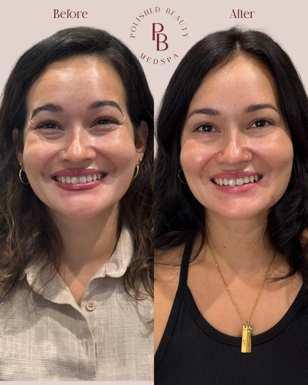 Wrinkle Relaxers at Polished Beauty
