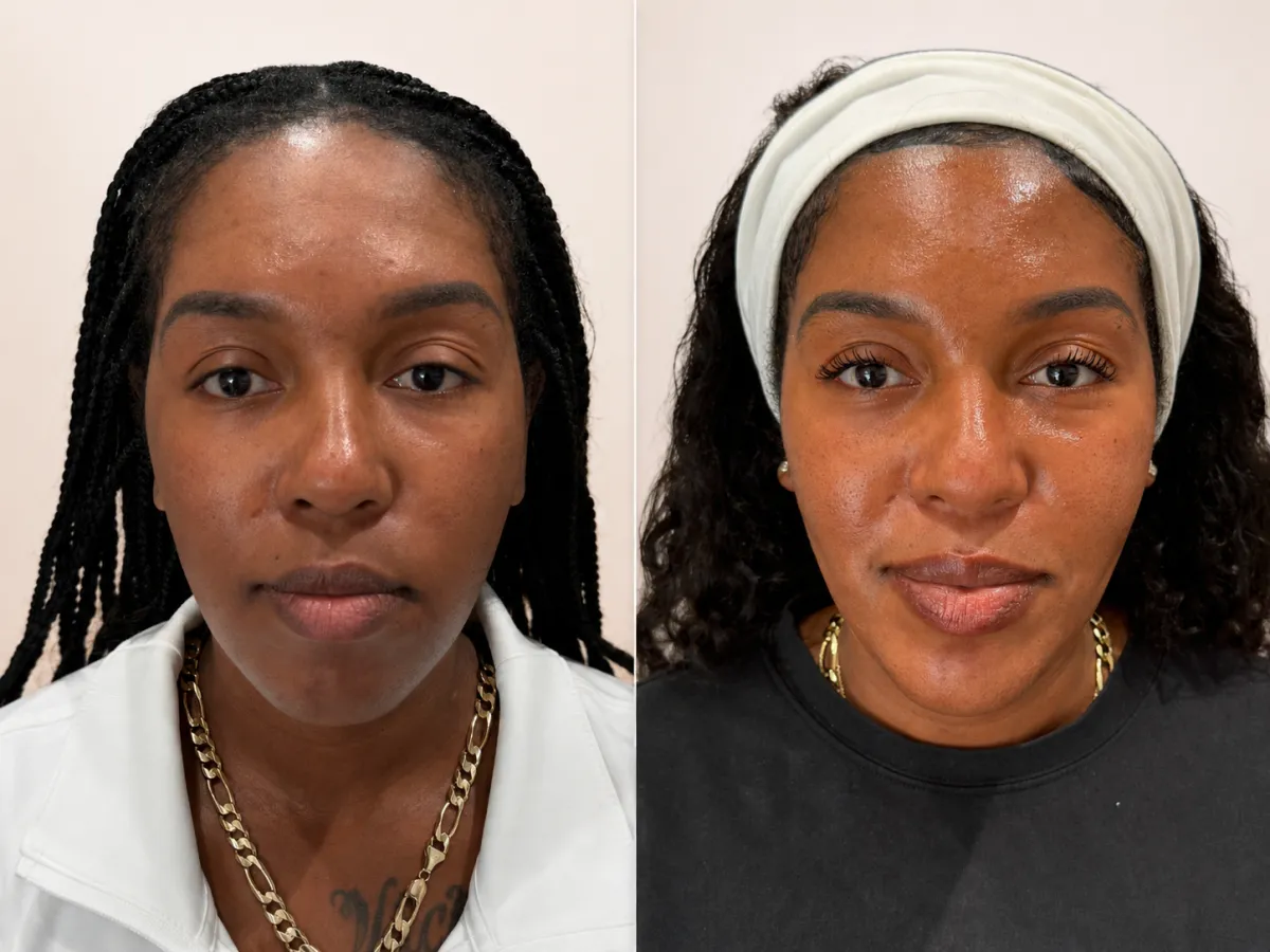 Facial Balancing treatment showing natural results