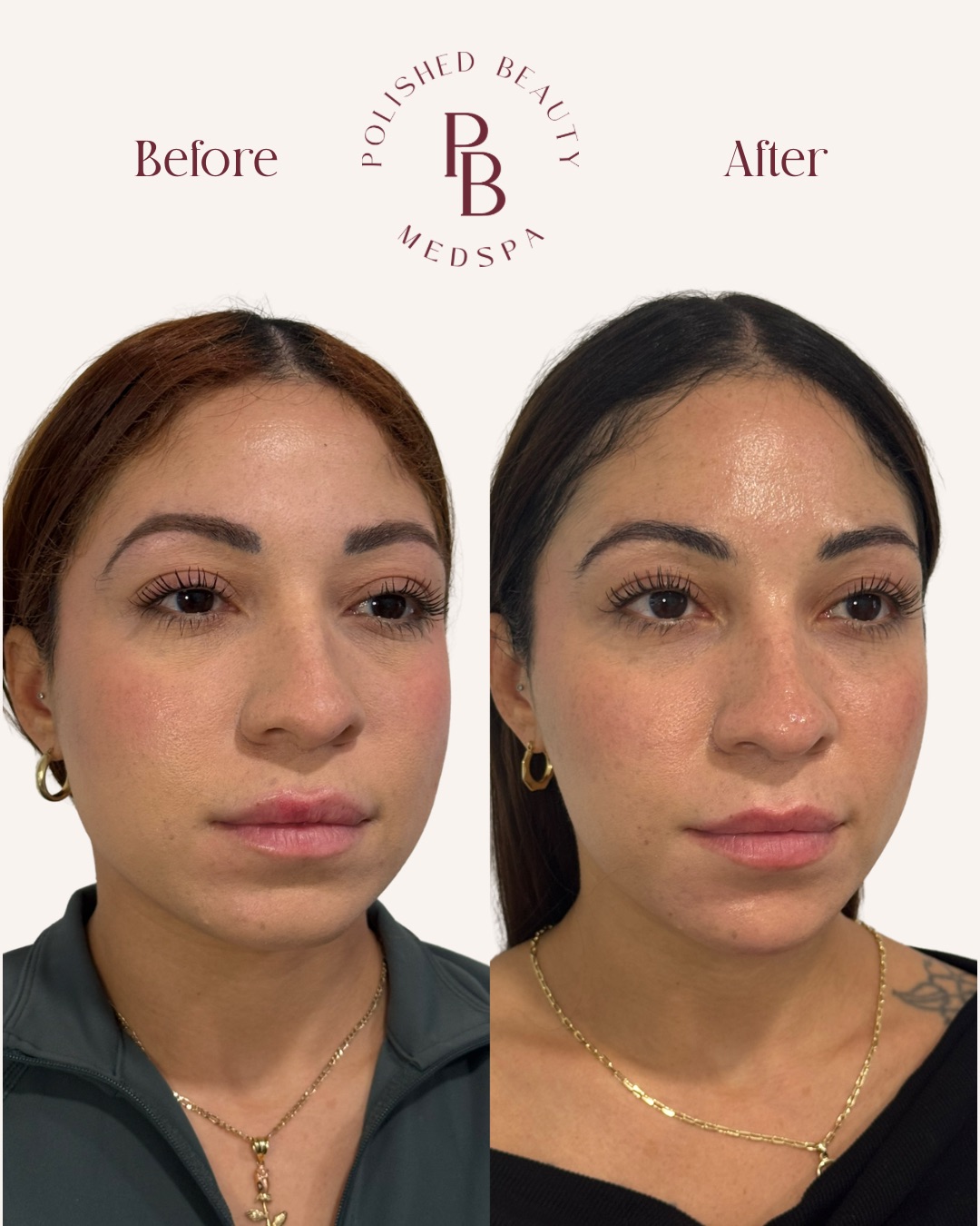 Dermal Fillers and Facial Balancing treatment at Polished Beauty