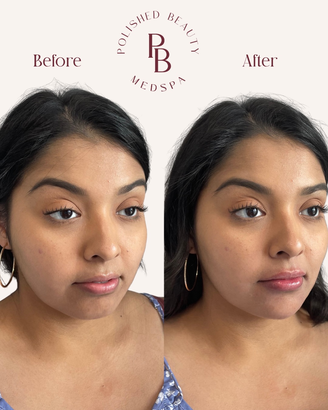 Before and after front views of an approved facial-balancing case