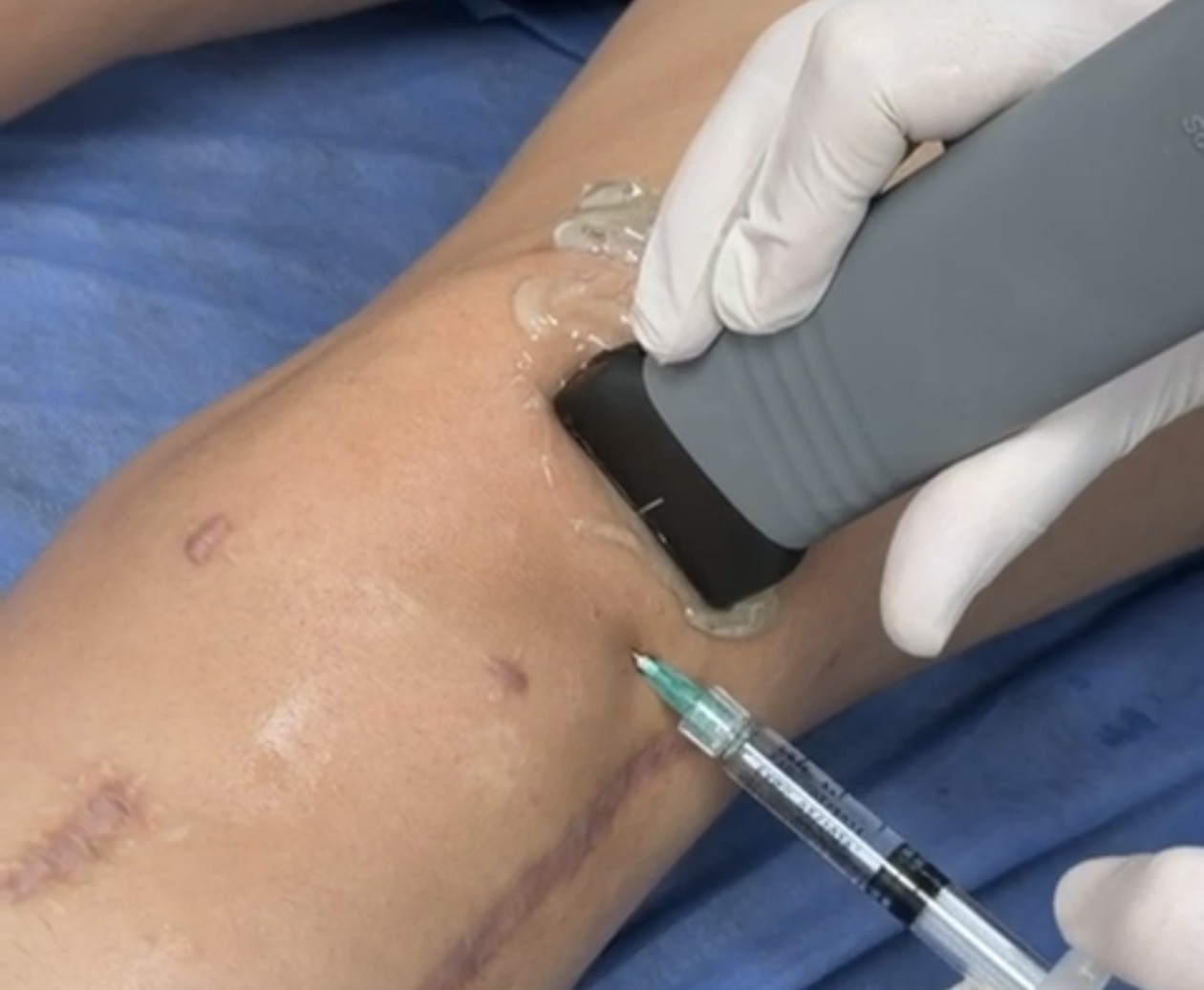 infiltraciones para el dolor de rodilla